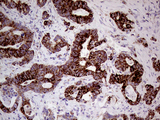 SHMT / SHMT2 Antibody - Immunohistochemical staining of paraffin-embedded Adenocarcinoma of Human colon tissue using anti-SHMT2 mouse monoclonal antibody. (Heat-induced epitope retrieval by 1mM EDTA in 10mM Tris buffer. (pH8.5) at 120°C for 3 min. (1:500)