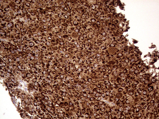 SHMT / SHMT2 Antibody - Immunohistochemical staining of paraffin-embedded Carcinoma of Human liver tissue using anti-SHMT2 mouse monoclonal antibody. (Heat-induced epitope retrieval by 1mM EDTA in 10mM Tris buffer. (pH8.5) at 120°C for 3 min. (1:500)