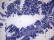 SHMT / SHMT2 Antibody - Immunohistochemical staining of paraffin-embedded Adenocarcinoma of Human ovary tissue using anti-SHMT2 mouse monoclonal antibody. (Heat-induced epitope retrieval by 1mM EDTA in 10mM Tris buffer. (pH8.5) at 120°C for 3 min. (1:150)