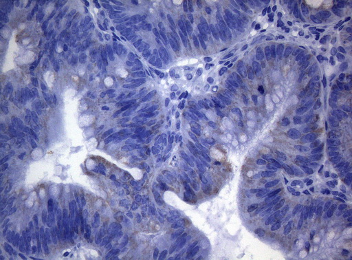 SHMT / SHMT2 Antibody - Immunohistochemical staining of paraffin-embedded Carcinoma of Human pancreas tissue using anti-SHMT2 mouse monoclonal antibody. (Heat-induced epitope retrieval by 1mM EDTA in 10mM Tris buffer. (pH8.5) at 120°C for 3 min. (1:150)
