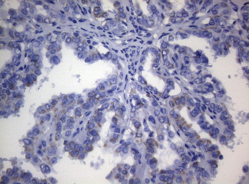 SHMT / SHMT2 Antibody - Immunohistochemical staining of paraffin-embedded Carcinoma of Human thyroid tissue using anti-SHMT2 mouse monoclonal antibody. (Heat-induced epitope retrieval by 1mM EDTA in 10mM Tris buffer. (pH8.5) at 120°C for 3 min. (1:150)
