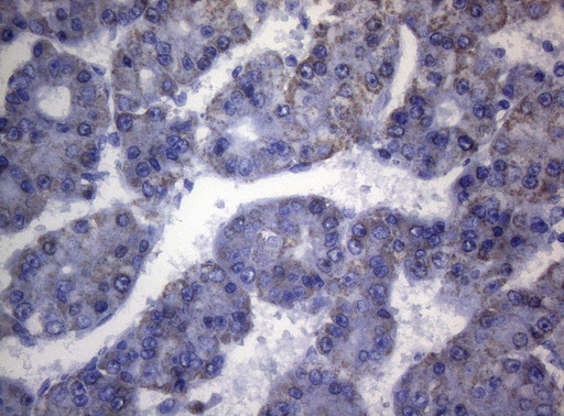 SHMT / SHMT2 Antibody - Immunohistochemical staining of paraffin-embedded Carcinoma of Human liver tissue using anti-SHMT2 mouse monoclonal antibody. (Heat-induced epitope retrieval by 1mM EDTA in 10mM Tris buffer. (pH8.5) at 120°C for 3 min. (1:150)