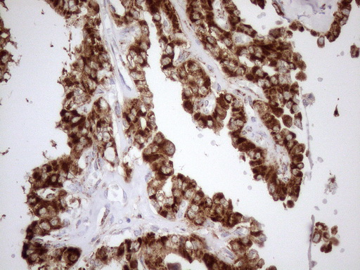 SHMT / SHMT2 Antibody - Immunohistochemical staining of paraffin-embedded Carcinoma of Human thyroid tissue using anti-SHMT2 mouse monoclonal antibody. (Heat-induced epitope retrieval by 1mM EDTA in 10mM Tris buffer. (pH8.5) at 120°C for 3 min. (1:150)