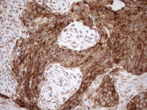 SHMT / SHMT2 Antibody - Immunohistochemical staining of paraffin-embedded Adenocarcinoma of Human endometrium tissue using anti-SHMT2 mouse monoclonal antibody. (Heat-induced epitope retrieval by 1mM EDTA in 10mM Tris buffer. (pH8.5) at 120°C for 3 min. (1:150)