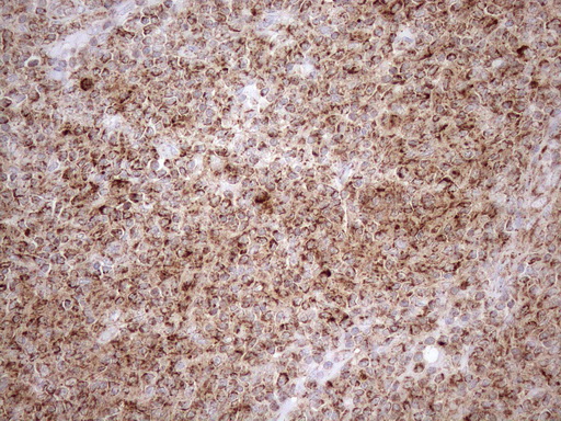 SHMT / SHMT2 Antibody - Immunohistochemical staining of paraffin-embedded Human lymphoma tissue using anti-SHMT2 mouse monoclonal antibody. (Heat-induced epitope retrieval by 1mM EDTA in 10mM Tris buffer. (pH8.5) at 120°C for 3 min. (1:150)