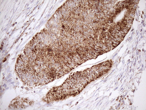 SHMT / SHMT2 Antibody - Immunohistochemical staining of paraffin-embedded Adenocarcinoma of Human colon tissue using anti-SHMT2 mouse monoclonal antibody. (Heat-induced epitope retrieval by 1mM EDTA in 10mM Tris buffer. (pH8.5) at 120°C for 3 min. (1:150)