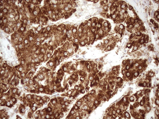 SHMT / SHMT2 Antibody - Immunohistochemical staining of paraffin-embedded Carcinoma of Human liver tissue using anti-SHMT2 mouse monoclonal antibody. (Heat-induced epitope retrieval by 1mM EDTA in 10mM Tris buffer. (pH8.5) at 120°C for 3 min. (1:150)