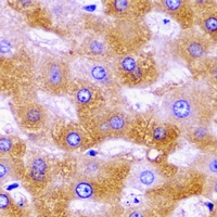 SHMT / SHMT2 Antibody - Immunohistochemical analysis of SHMT2 staining in human liver cancer formalin fixed paraffin embedded tissue section. The section was pre-treated using heat mediated antigen retrieval with sodium citrate buffer (pH 6.0). The section was then incubated with the antibody at room temperature and detected using an HRP conjugated compact polymer system. DAB was used as the chromogen. The section was then counterstained with hematoxylin and mounted with DPX.