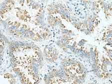 SHOOTIN1 / KIAA1598 Antibody - Immunohistochemistry of paraffin-embedded Human lung cancer tissue  using SHTN1 Polyclonal Antibody at dilution of 1:30(×200)