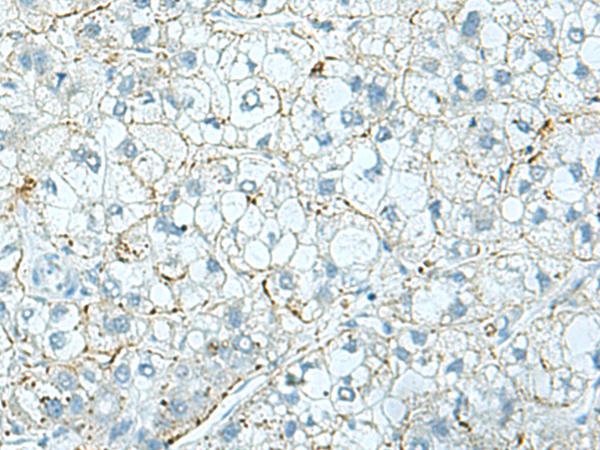 SHOOTIN1 / KIAA1598 Antibody - Immunohistochemistry of paraffin-embedded Human liver cancer tissue  using SHTN1 Polyclonal Antibody at dilution of 1:30(×200)