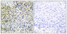 SHPK / CARKL Antibody - Immunohistochemistry analysis of paraffin-embedded human liver carcinoma tissue, using CARKL Antibody. The picture on the right is blocked with the synthesized peptide.