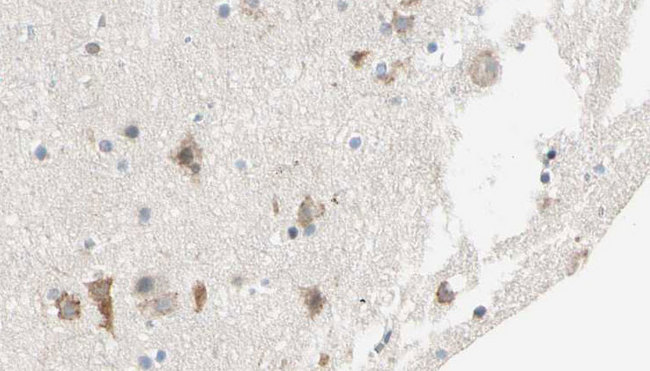 SHPK / CARKL Antibody - 1:100 staining human brain carcinoma tissue by IHC-P. The sample was formaldehyde fixed and a heat mediated antigen retrieval step in citrate buffer was performed. The sample was then blocked and incubated with the antibody for 1.5 hours at 22°C. An HRP conjugated goat anti-rabbit antibody was used as the secondary.