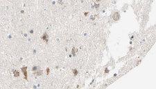 SHPK / CARKL Antibody - 1:100 staining human brain carcinoma tissue by IHC-P. The sample was formaldehyde fixed and a heat mediated antigen retrieval step in citrate buffer was performed. The sample was then blocked and incubated with the antibody for 1.5 hours at 22°C. An HRP conjugated goat anti-rabbit antibody was used as the secondary.