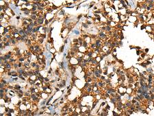 SHPK / CARKL Antibody - Immunohistochemistry of paraffin-embedded Human ovarian cancer tissue  using SHPK Polyclonal Antibody at dilution of 1:45(×200)