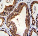 SHQ1 Antibody - SHQ1 Antibody immunohistochemistry of formalin-fixed and paraffin-embedded human prostate carcinoma followed by peroxidase-conjugated secondary antibody and DAB staining.