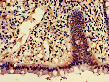 SHREW-1 / AJAP1 Antibody - Immunohistochemistry of paraffin-embedded human colon cancer using AJAP1 Antibody at dilution of 1:100