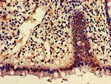 SHREW-1 / AJAP1 Antibody - Immunohistochemistry of paraffin-embedded human colon cancer using AJAP1 Antibody at dilution of 1:100