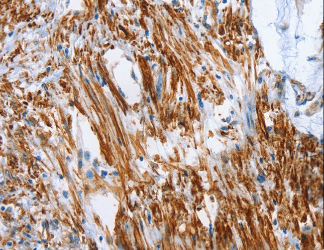 SHROOM2 Antibody - Immunohistochemistry of paraffin-embedded Human cervical cancer using SHROOM2 Polyclonal Antibody at dilution of 1:50.