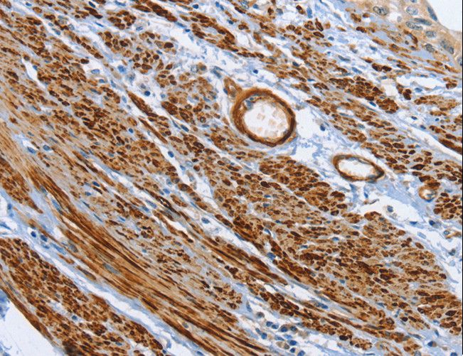 SHROOM2 Antibody - Immunohistochemistry of paraffin-embedded Human cervical cancer using SHROOM2 Polyclonal Antibody at dilution of 1:50.