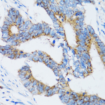 SIAH1 Antibody - Immunohistochemistry of paraffin-embedded human colon carcinoma tissue.