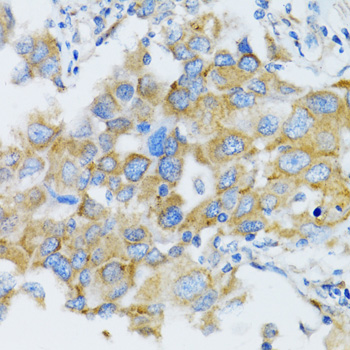 SIAH1 Antibody - Immunohistochemistry of paraffin-embedded human breast cancer tissue.