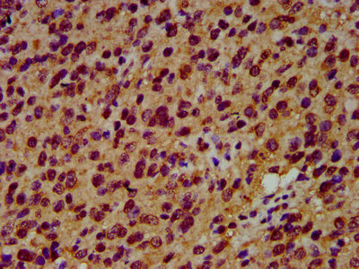SIAH2 Antibody - Immunohistochemistry Dilution at 1:600 and staining in paraffin-embedded human glioma cancer performed on a Leica BondTM system. After dewaxing and hydration, antigen retrieval was mediated by high pressure in a citrate buffer (pH 6.0). Section was blocked with 10% normal Goat serum 30min at RT. Then primary antibody (1% BSA) was incubated at 4°C overnight. The primary is detected by a biotinylated Secondary antibody and visualized using an HRP conjugated SP system.
