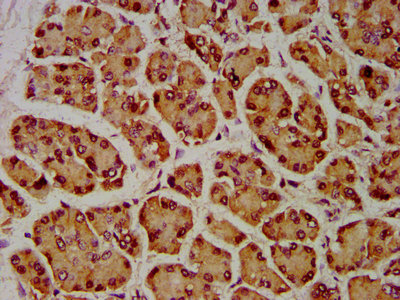SIAH2 Antibody - Immunohistochemistry Dilution at 1:600 and staining in paraffin-embedded human pancreatic cancer performed on a Leica BondTM system. After dewaxing and hydration, antigen retrieval was mediated by high pressure in a citrate buffer (pH 6.0). Section was blocked with 10% normal Goat serum 30min at RT. Then primary antibody (1% BSA) was incubated at 4°C overnight. The primary is detected by a biotinylated Secondary antibody and visualized using an HRP conjugated SP system.
