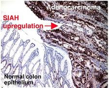 SIAH2 Antibody - Staining of SIAH in human colorectal adenocarcinoma. Staining of SIAH was not observed in normal colon epithelium.