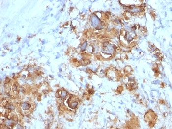 Sialylated Lewis a / CA 19-9 Antibody - Formalin-fixed, paraffin-embedded human gastric carcinoma stained with CA19-9 antibody (121SLE).  This image was taken for the unmodified form of this product. Other forms have not been tested.