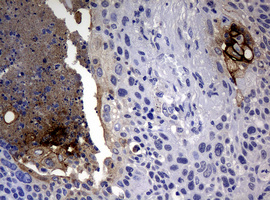 Sialylated Lewis a / CA 19-9 Antibody - IHC of paraffin-embedded Carcinoma of Human lung tissue using anti-CA19-9 mouse monoclonal antibody.