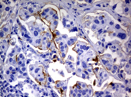 Sialylated Lewis a / CA 19-9 Antibody - IHC of paraffin-embedded Carcinoma of Human bladder tissue using anti-CA19-9 mouse monoclonal antibody.