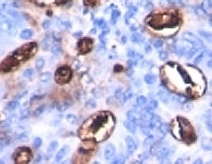 Sialylated Lewis a / CA 19-9 Antibody - Formalin-fixed, paraffin-embedded human colon carcinoma stained with CA19-9 antibody (SPM588).  This image was taken for the unmodified form of this product. Other forms have not been tested.