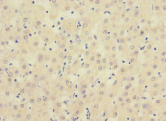SIGIRR Antibody - Immunohistochemistry of paraffin-embedded human liver cancer at dilution 1:100