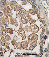 SIGLEC11 Antibody - Formalin-fixed and paraffin-embedded human lung carcinoma tissue reacted with SIGLEC11 antibody (N-term) , which was peroxidase-conjugated to the secondary antibody, followed by DAB staining. This data demonstrates the use of this antibody for immunohistochemistry; clinical relevance has not been evaluated.