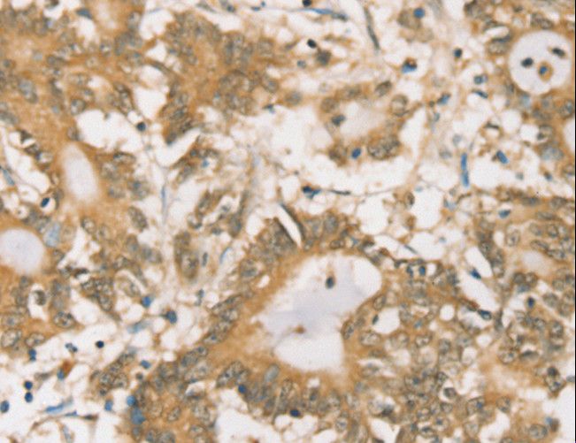 SIGLEC15 Antibody - Immunohistochemistry of paraffin-embedded Human lung cancer using SIGLEC15 Polyclonal Antibody at dilution of 1:35.