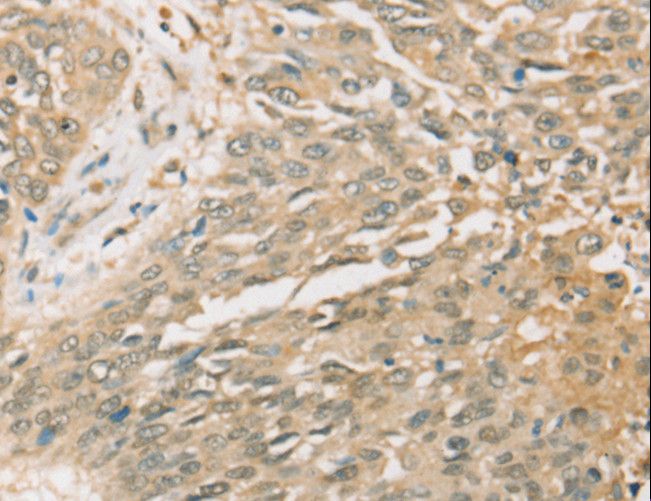 SIGLEC15 Antibody - Immunohistochemistry of paraffin-embedded Human lung cancer using SIGLEC15 Polyclonal Antibody at dilution of 1:35.