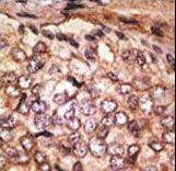 SIGLEC5 / CD170 Antibody - Formalin-fixed and paraffin-embedded human cancer tissue reacted with the primary antibody, which was peroxidase-conjugated to the secondary antibody, followed by DAB staining. This data demonstrates the use of this antibody for immunohistochemistry; clinical relevance has not been evaluated. BC = breast carcinoma; HC = hepatocarcinoma.