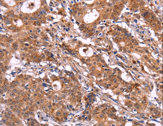 SIGLEC5 / CD170 Antibody - Immunohistochemistry of paraffin-embedded Human gastric cancer using SIGLEC5 Polyclonal Antibody at dilution of 1:30.