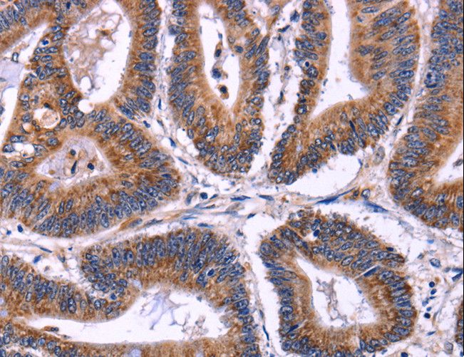 SIGLEC5 / CD170 Antibody - Immunohistochemistry of paraffin-embedded Human colon cancer using SIGLEC5 Polyclonal Antibody at dilution of 1:30.