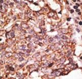 SIGLEC6 Antibody - Formalin-fixed and paraffin-embedded human cancer tissue reacted with the primary antibody, which was peroxidase-conjugated to the secondary antibody, followed by AEC staining. This data demonstrates the use of this antibody for immunohistochemistry; clinical relevance has not been evaluated. BC = breast carcinoma; HC = hepatocarcinoma.