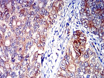 SIGLEC6 Antibody - Immunohistochemical analysis of paraffin-embedded cervical cancer tissues using CD327 mouse mAb with DAB staining.