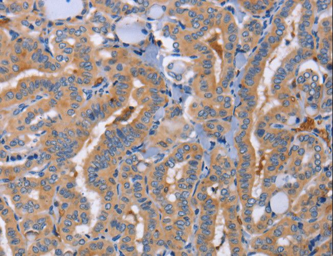 SIGLEC6 Antibody - Immunohistochemistry of paraffin-embedded Human thyroid cancer using SIGLEC6 Polyclonal Antibody at dilution of 1:70.