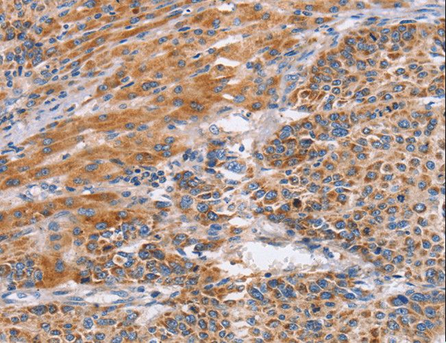 SIGLEC6 Antibody - Immunohistochemistry of paraffin-embedded Human liver cancer using SIGLEC6 Polyclonal Antibody at dilution of 1:60.