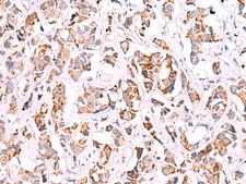 SIGLEC6 Antibody - Immunohistochemistry of paraffin-embedded Human breast cancer tissue  using SIGLEC6 Polyclonal Antibody at dilution of 1:50(×200)