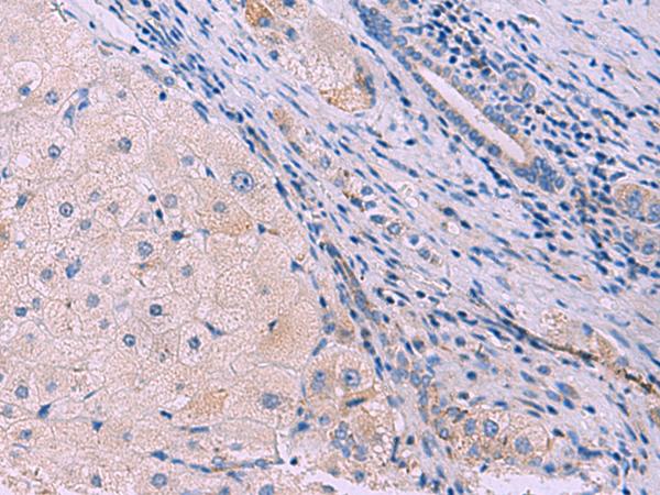 SIGLEC6 Antibody - Immunohistochemistry of paraffin-embedded Human liver cancer tissue  using SIGLEC6 Polyclonal Antibody at dilution of 1:50(×200)