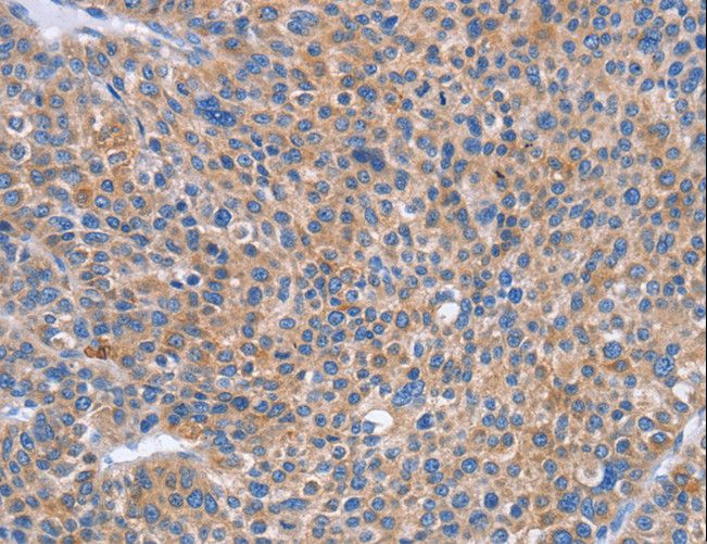 SIGLEC7 / CD328 Antibody - Immunohistochemistry of paraffin-embedded Human liver cancer using SIGLEC7 Polyclonal Antibody at dilution of 1:50.