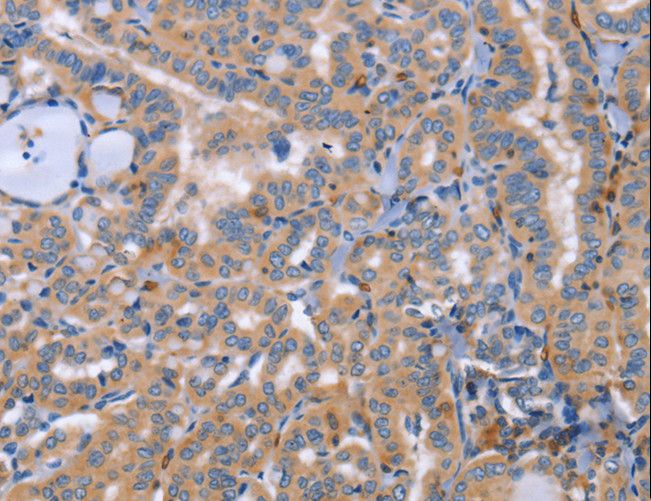 SIGLEC7 / CD328 Antibody - Immunohistochemistry of paraffin-embedded Human thyroid cancer using SIGLEC7 Polyclonal Antibody at dilution of 1:50.