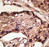 SIGLEC9 Antibody - Formalin-fixed and paraffin-embedded human cancer tissue reacted with the primary antibody, which was peroxidase-conjugated to the secondary antibody, followed by AEC staining. This data demonstrates the use of this antibody for immunohistochemistry; clinical relevance has not been evaluated. BC = breast carcinoma; HC = hepatocarcinoma.