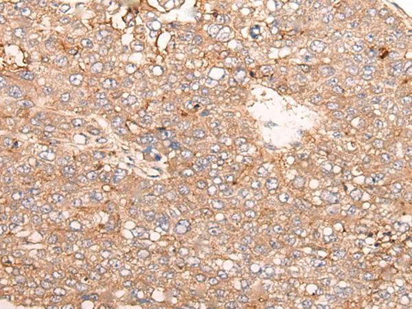 SIGLECL1 Antibody - Immunohistochemistry of paraffin-embedded Human liver cancer tissue  using SIGLECL1 Polyclonal Antibody at dilution of 1:65(×200)