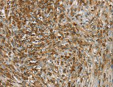 SIK1 / MSK Antibody - Immunohistochemistry of paraffin-embedded Human cervical cancer using SIK1 Polyclonal Antibody at dilution of 1:40.
